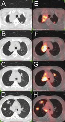 Case report: Rare epithelioid hemangioendothelioma occurs in both main bronchus and lung